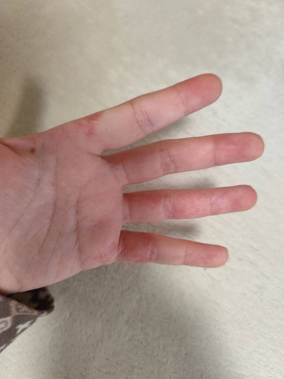 アトピー治癒の奇跡：写真3（改善前）