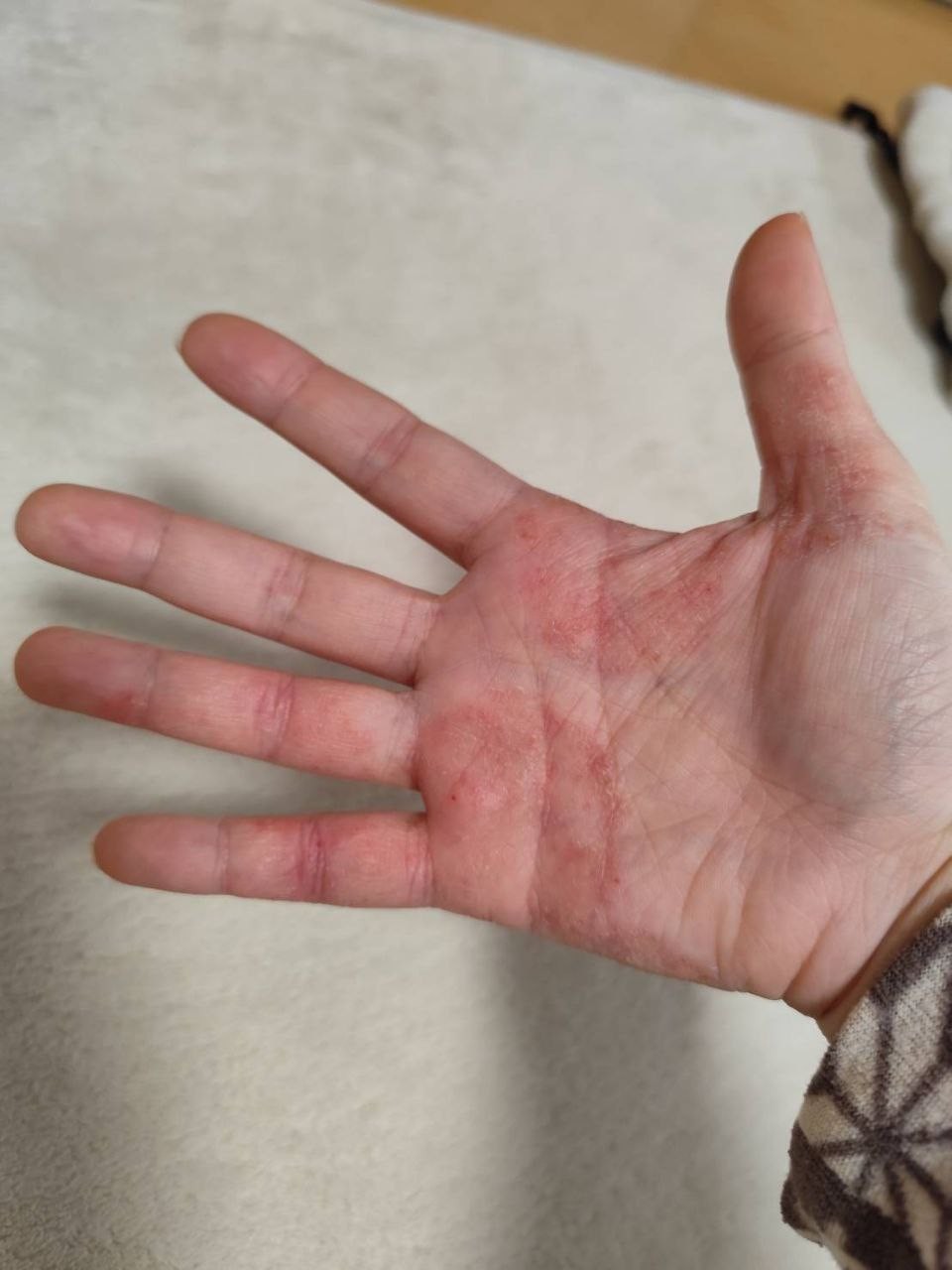 アトピー治癒の奇跡：写真1（改善前）