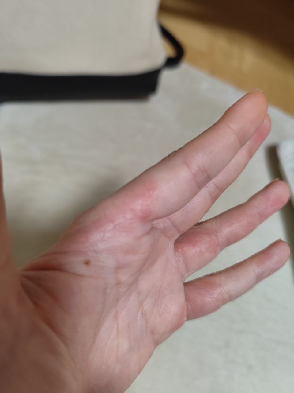 アトピー治癒の奇跡：写真4（改善後）