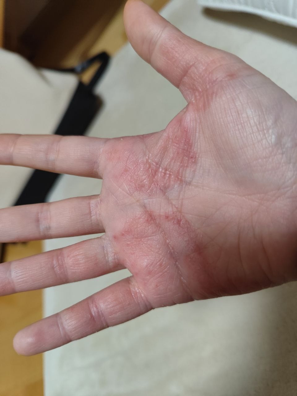 アトピー治癒の奇跡：写真2（改善後）